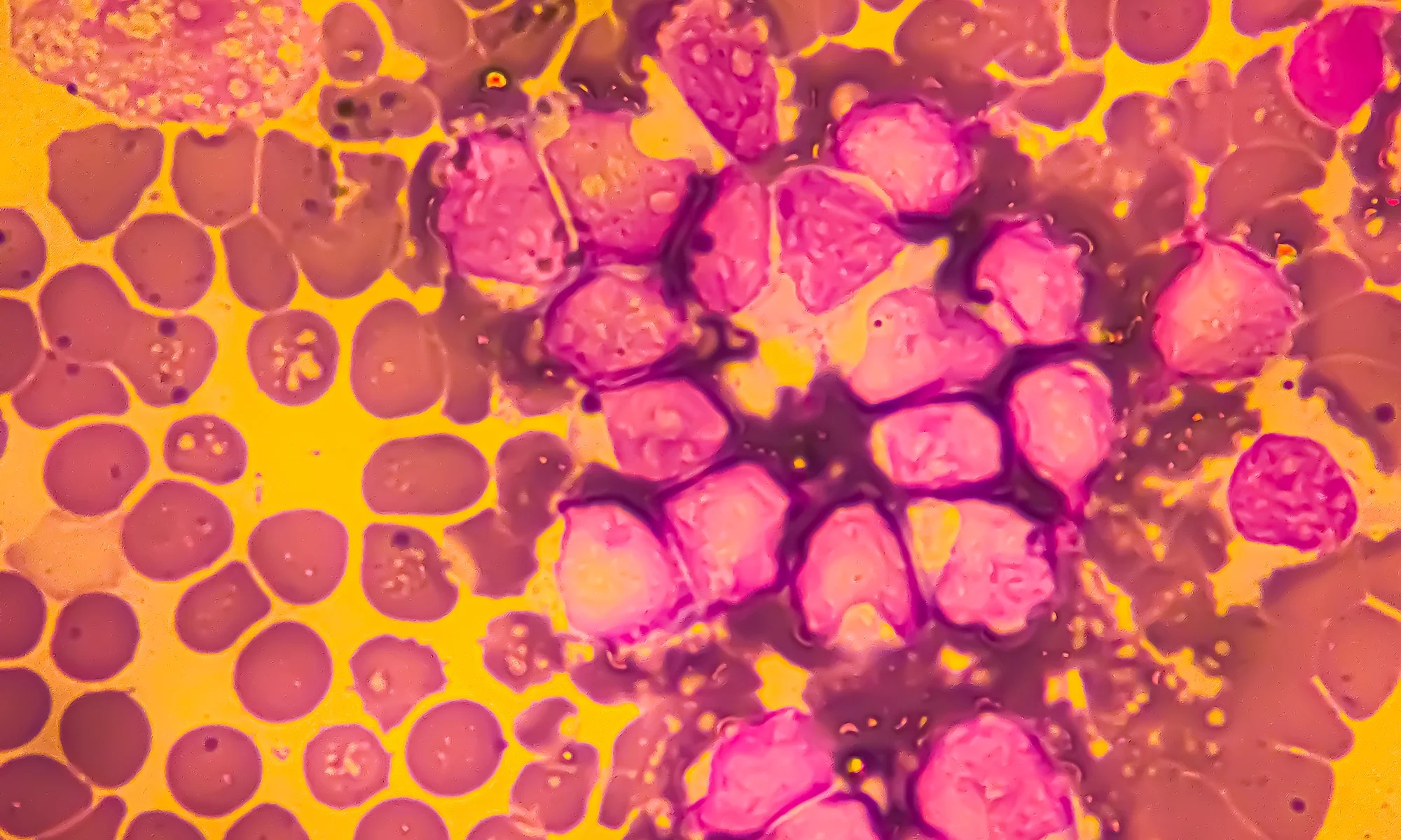 Microscope image of cancer cells and normal cells