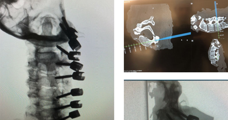 Collage of x-ray photos of the spine with surgical screws